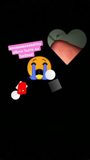 #cute ouch ouch my elbow hurts so badaaa!