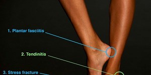 4 foot injuries to watch out for while running