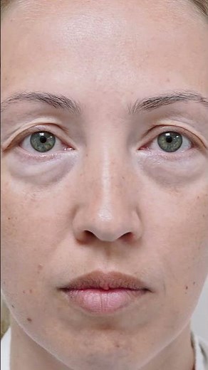 Blepharoplasty. Before & After.