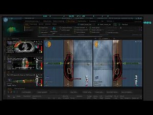 Breast 3D -CRT Planning using Raystation TPS