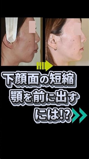 下顔面の短縮!!顎を前に出すには!? 斉宮院長が解説します #歯医者 #小顔 #矯正＃口ゴボ #ガミースマイル #歯列矯正 #オートローテーション #顎の後退