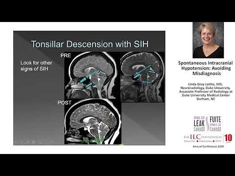 Linda Gray Leithe, MD, Neuroradiology | Spontaneous Intracranial Hypotension: Avoiding Misdiagnosis