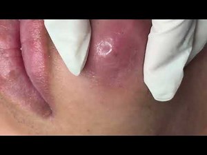 Pimple popping | Cystic Acne Extraction | Cyst Popping this week #1