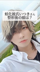 [Double Eyelid Surgery] What does Itsuki's face look like after his "frog-like" surgery? #shorts