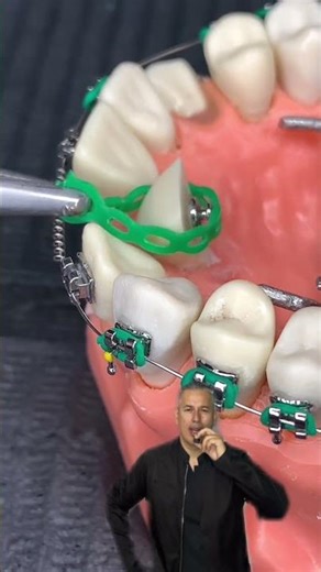 🔥Metal Button with Orthodontic Mesh🔥