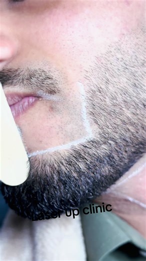 #laserupclinic #kamranclinic #kamranclinic #laserhairremoval #pleaseunfrezzemyaccount