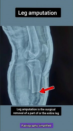 Leg amputation #radiology #orthopedic #emergency #hospital #trauma