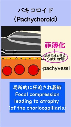 Understand Pachychoroid in 1 Minute: Key OCT and ICGA Findings