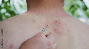 The process of extracting bee sting from the human body. Bee stings for health and healing. Allergy to insect stings, honey bees Stock Video