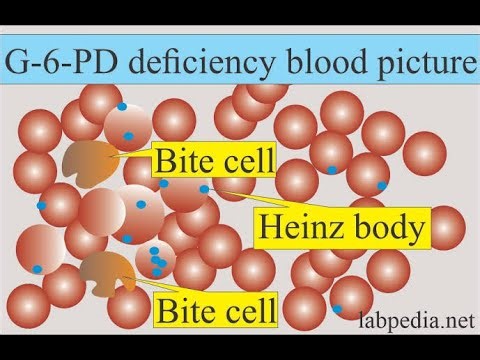 Pathophysiology of Glucose 6 phosphate dehydrogenase G6PD Deficiency