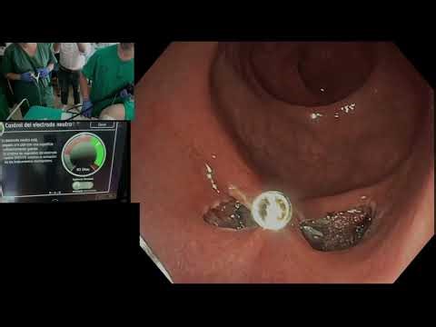 DAT clip review and handling of the new Micro-tech closing clip