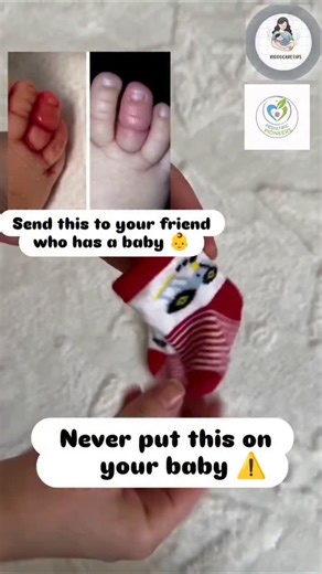 PEDIATRICS | PARENTING COACH | MILESTONE on Instagram: "Sometimes tight socks, mittens, or a strand of hair/thread can wrap around a baby’s finger or toe and block blood circulation. This is called hair or thread tourniquet syndrome ⚠️ It can cause swelling, redness, pain, and if not noticed early, serious injury. ✔ Check your baby’s fingers and toes daily 👶 ✔ Use soft, loose cotton socks or mittens 🧦 ✔ If you see swelling, redness, or excessive crying → check immediately and consult a pediatr