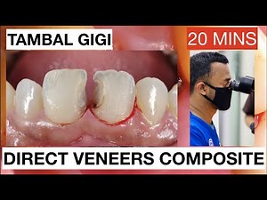 Step by Step Direct Veneers Composite Anterior Multiple Cases  • Video • MEDtube.net