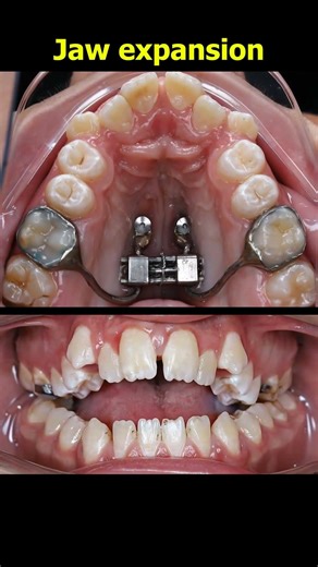 ✨Jaw expansion technique in growth orthodontics before braces #braces #orthodontist #dentist