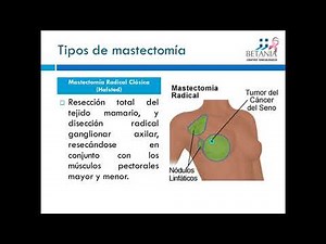 Mastectomía