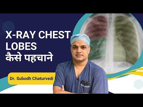X-ray Chest : How to Diagnose which lobe is involved in Pneumonia