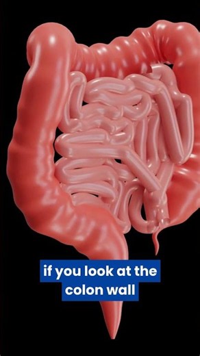 Colonic diverticulosis