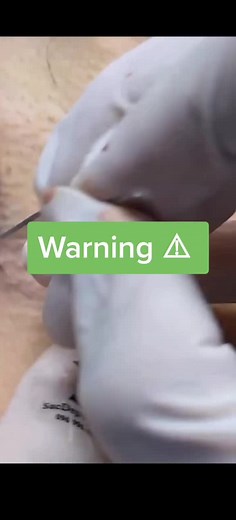 ForTheLoveOfPimples on TikTok