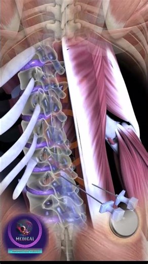 Spinal Cord Stimulation: The "Pacemaker" for Chronic Pain Relief