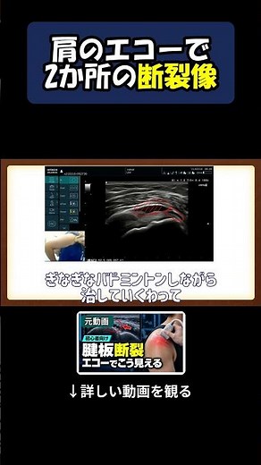 なぜ肩が痛い？エコー検査でわかった衝撃の事実 #腱板断裂 #エコー #整形外科