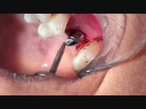 Cementation on implant crown