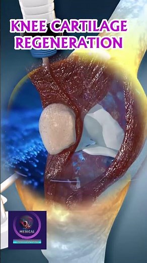 Knee Cartilage Regeneration - Osteoarthritis Treatment
