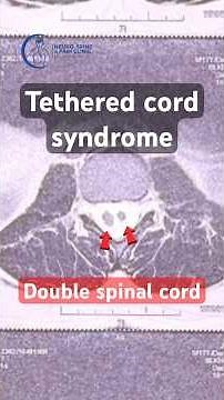 Double spinal cord || Tethered cord syndrome || Spinal tumour