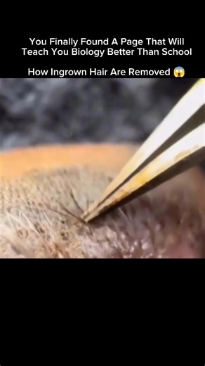 Explaining Biology on Instagram: "HOW INGROWN HAIRS ARE REMOVED 😱 An ingrown hair happens when the hair grows back into the skin instead of coming out, often after shaving or waxing 😬 This can cause redness, pain, bumps, and pus if infected. 🔹 Step 1: Clean the area The skin is washed and disinfected to kill bacteria and prevent infection. 🔹 Step 2: Open the skin gently A warm compress or sterile needle is used to slightly open the top layer of skin — never deep digging ⚠️ 🔹 Step 3: Release