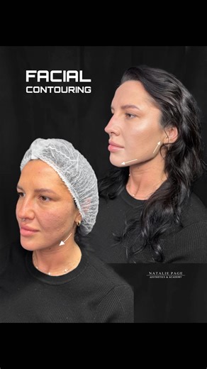 213K views · 739 reactions | Facial Profiling: Small Volume, Big...