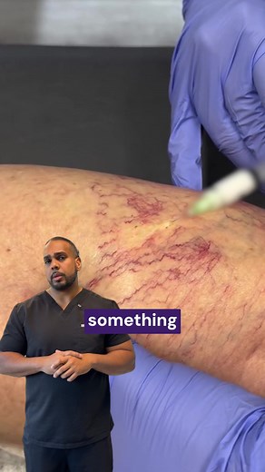 “Faulty veins?” What does that even mean? 👀 Dr. Deygoo explains it simply: when the valves in your veins struggle to push blood back up to your heart, it’s called chronic venous insufficiency. That can lead to heaviness, leg fatigue, swelling, and aching that won’t quit. 👉🏼 Click the link in our bio ☎️ Or call 844-382-8422 now! #VaricoseVeins #HealthyLegs #SpiderVeins #Wellness #Health