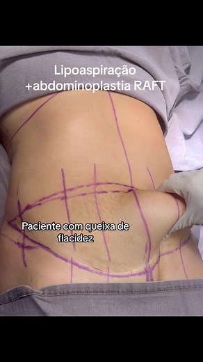 Lipoaspiração e Abdominoplastia RAFT: Transforme seu Corpo