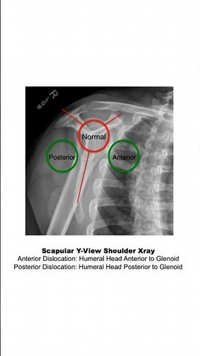 Scapular Y-View Shoulder Xray #radiology #medicalimaging #mbbs #nursing