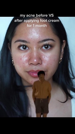 Clear Skin Journey: How Foot Cream Helped My Acne Transformation