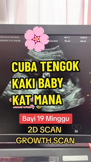 Baby Growth Scan at 19 Weeks: What to Expect