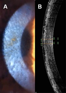Epithelial-stromal TGFBI-associated corneal dystrophies: for professionals - Gene Vision