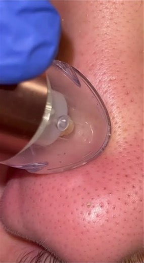 Best Blackhead Removal Tool 2024-2026: Deep Pore Vacuum for Clear Skin