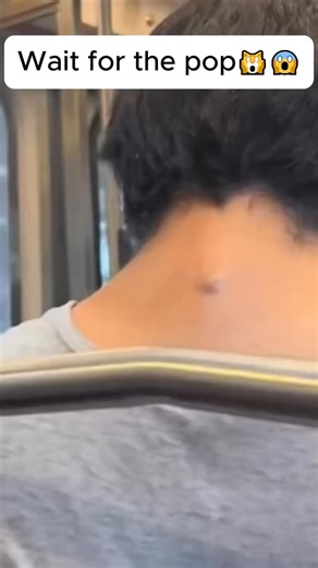 15K views · 82 reactions | #poppingpimples #blackheadsextraction #whiteheadsextraction #zit #extraction #oddlysatisfying #acne #drpimplepopper #doctor (8) | News Report Pro | Facebook