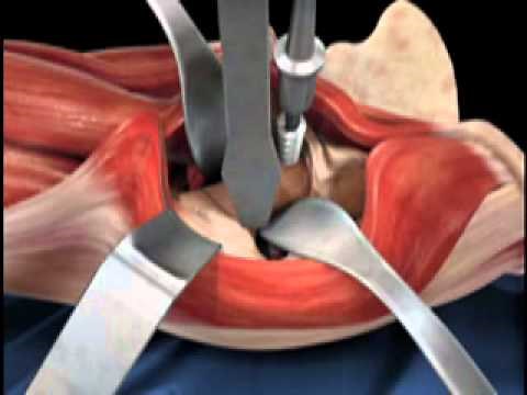 Depuy Direct Anterior Total Hip Replacement Animated Video