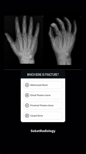 Proximal Phalanx Fracture: X-Ray Quiz Challenge