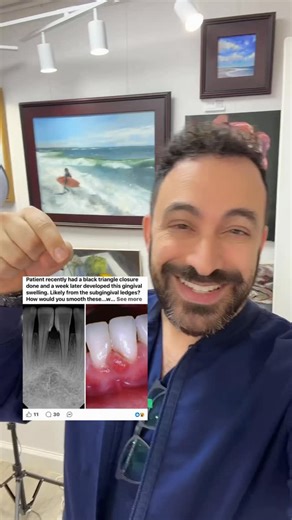 Dr. Erez Cohen LANAP Dentist on Instagram: "Great comparison of standard Black Triangle closure with a Mylar strip vs Bioclear Black Triangle! @bioclearmatrix #bioclear #blacktriangle #gumdisease #oralhealthcare #gumrecession"
