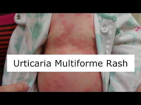 Urticaria Multiforme Rash
