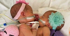 Parents share extraordinary story of conjoined twins separated by surgery