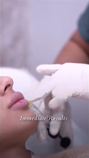 Natural Lip Fillers Explained | Before & After by Dermatologist