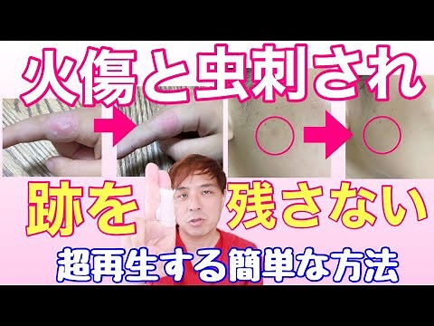 【火傷の跡 】火傷の跡虫刺され 傷跡を残さない方法