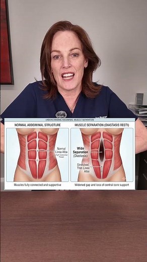 What is diastasis recti