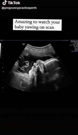 Yawning is one of the indicators that baby is tired outside the womb. We know that unborn babies hiccup,swallow and stretch in the womb, yawing can be linked to fetal developmental, although the function and importance of yawing is unknown. How amazing is this seeing your baby in the womb hiccup, swallow and yawn. Do you remember these precious moments in your pregnancy? Please share 🤰 #perthpregnancy #pregnancypracticeperth #midwiferymodelofcare #pregnancycare #pregnacycaretips #birthwithoutfe