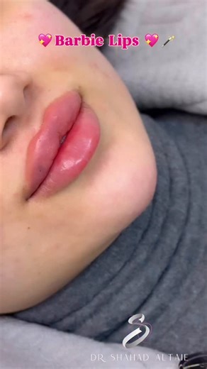doctor lipsss 🪄🧚🏻‍♂️ on Instagram: "Barbie Lips 👄 🎀 ✨"