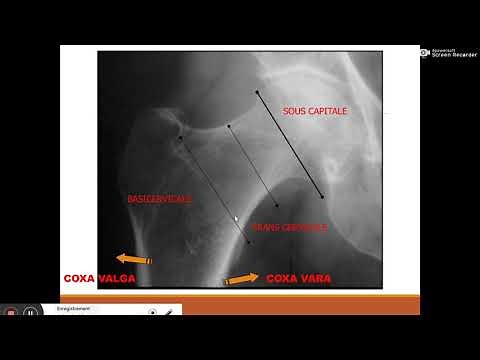 fracture du col femoral