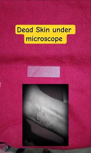 This Is What Burnt Skin Looks Like Under Microscope