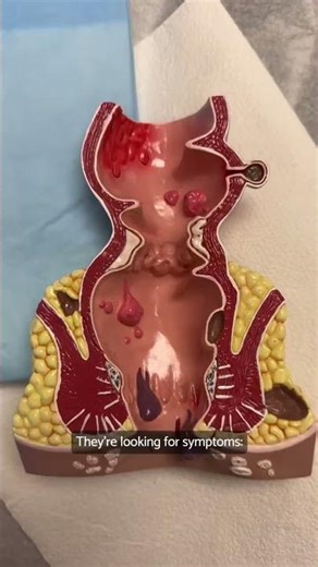 Is it normal or is it Colon Cancer?